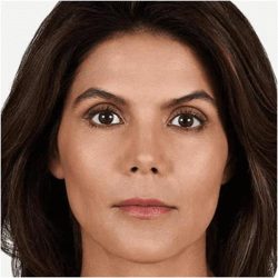 JUVÉDERM® VOLUMA® XC Before & After Patient #1653